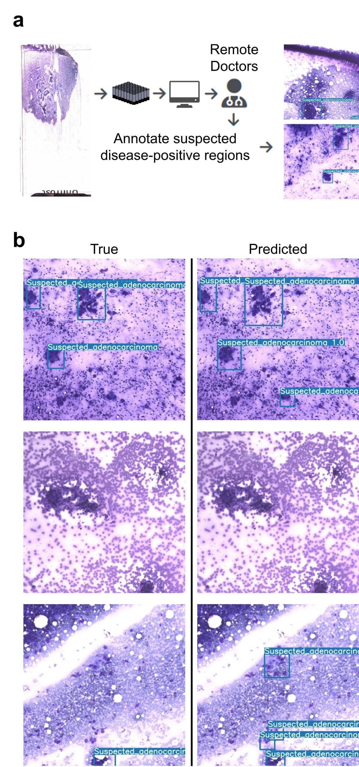 Detection of suspected adenocarcinoma in lung specimens using YOLOv7