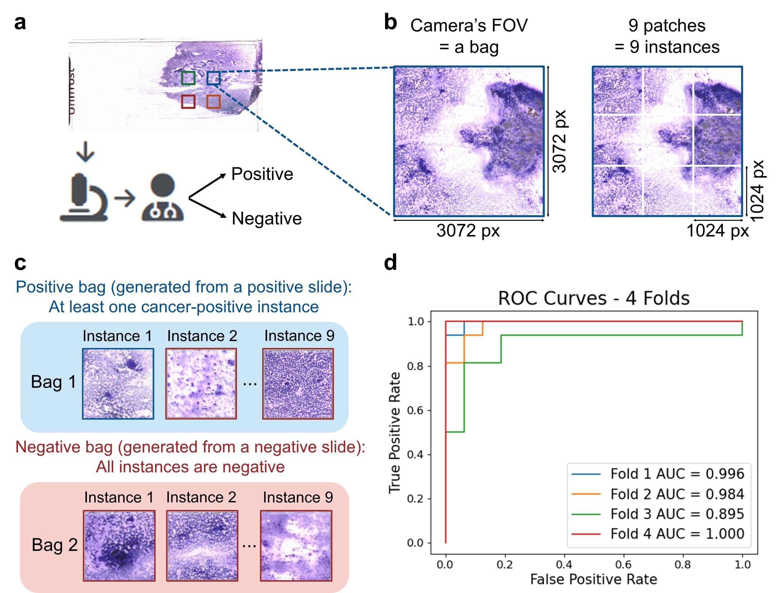 Implementation of multiple instance learning (MIL) for accurate slide-level automated diagnosis